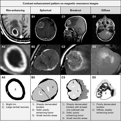 Breakouts—A Radiological Sign of Poor Prognosis in Patients With Brain Metastases